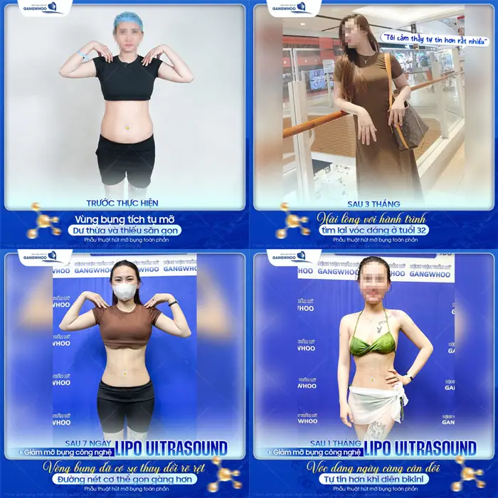 Hút Mỡ Toàn Thân Có Nguy Hiểm Không? 1 Kết quả sau 3 tháng giãm mỡ bụng công nghệ Lipo Ultrasound vòng eo thon nuột tự tin thả dáng đẹp xuất sắc