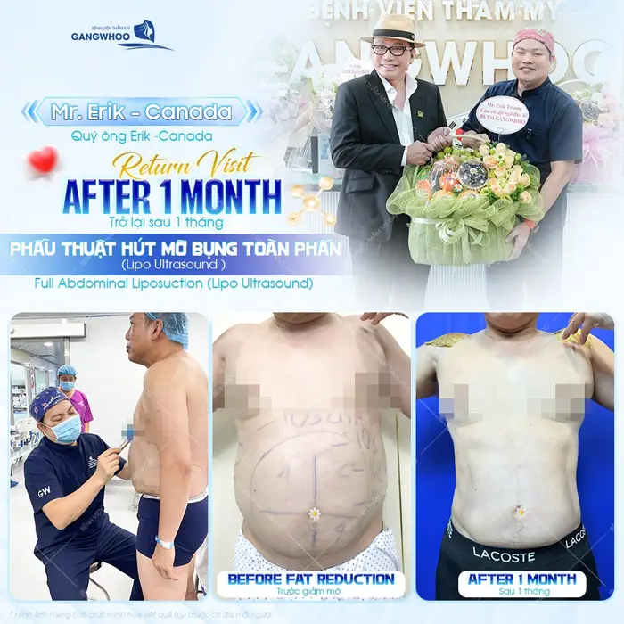 Phẫu thuật hút mỡ bụng toàn phần tự tin hơn với vóc dáng mới săn chắc thon gọn