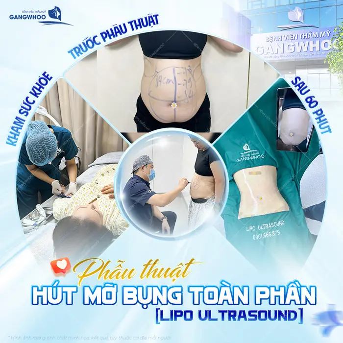 Phẫu thuật hút mỡ bụng toàn phần sự cải thiện rõ rệt sau 60 phút thực hiện