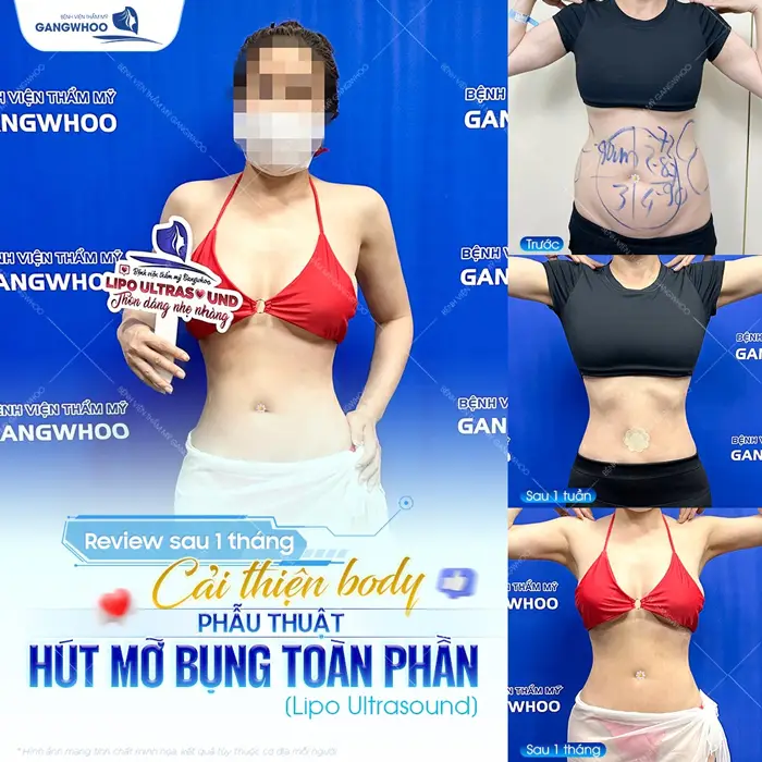 Hút Mỡ Bụng Có Bị Béo Lại Không? Nguyên Nhân Gây Béo Lại