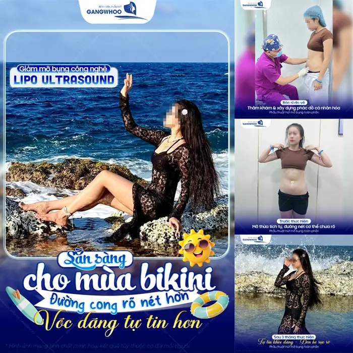 Giảm mỡ công nghệ Lipo Ultrasound đường cong rõ nét tự tin diện bikini với vóc dáng nuột nà