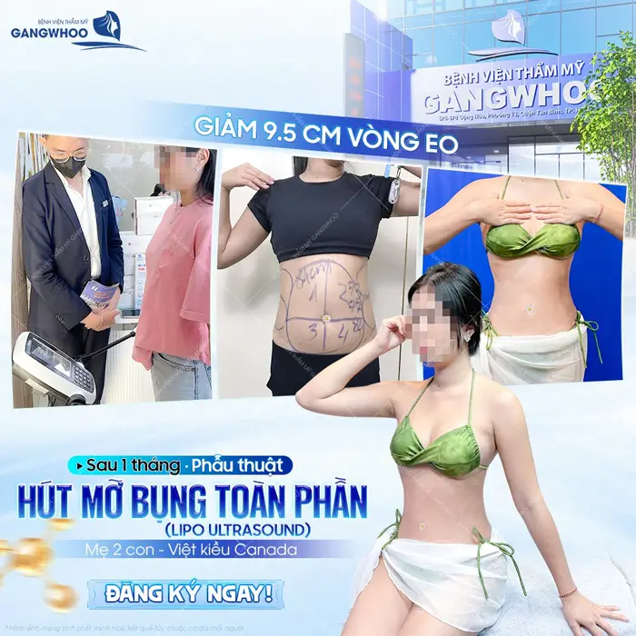 Phẫu thuật hút mỡ bụng toàn phần sự cải thiện rõ rệt sau 60 phút thực hiện