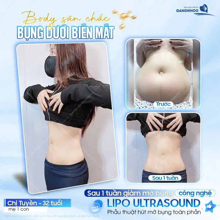 Body săn chắc bụng dưới biến mất sau 1 tuần giảm mỡ bụng công nghệ Lip Ultrasound đã hoàn toàn khác biệt 