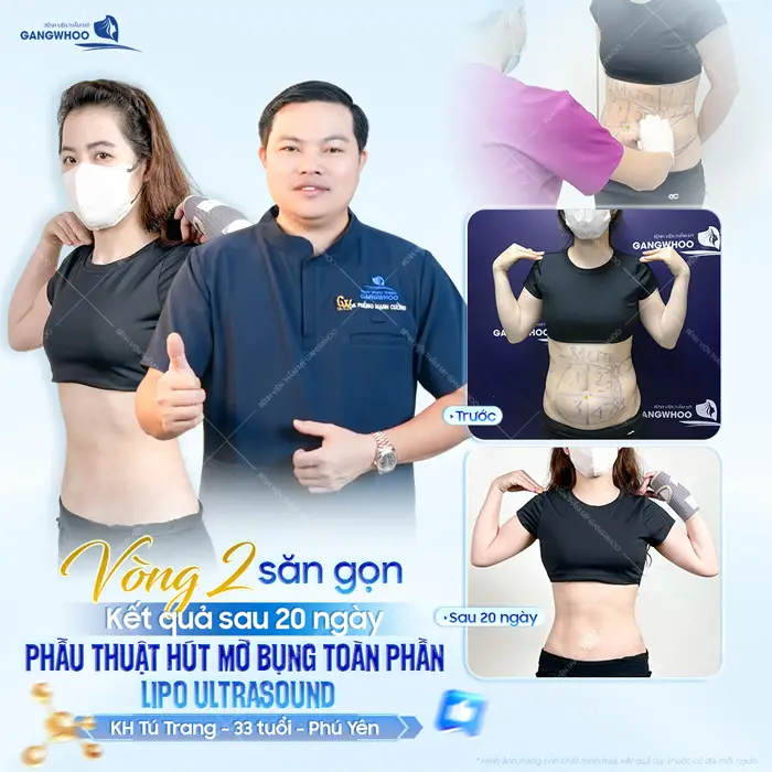 Vòng 2 săn gọn kết quả sau 20 ngày thực hiện phẫu thuật hút mỡ bụng toàn phần Lipo Ultrasound