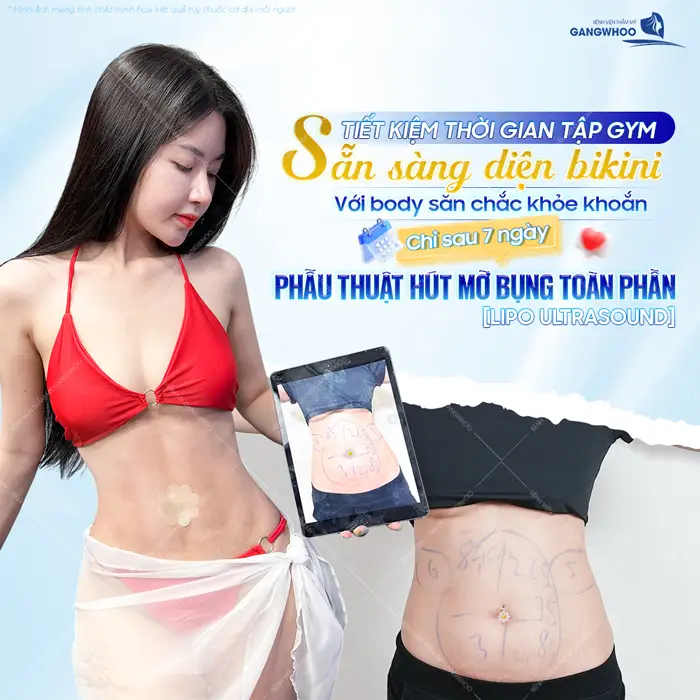 Phẫu thuật hút mỡ bụng toàn phần tự tin khoe body phẳng nuột sau 7 ngày can thiệp 