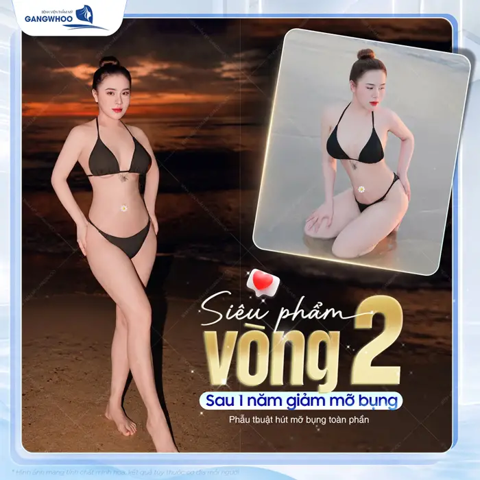 Siêu phẩm vòng 2 sau 1 năm giảm mỡ bụng Lipo Ultrasound 