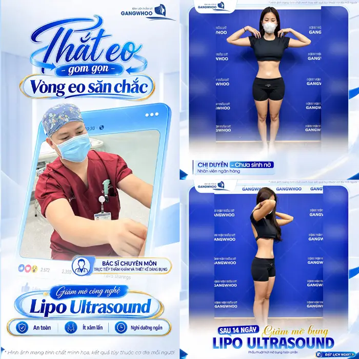 Hút Mỡ Bụng Có Bị Béo Lại Không? Nguyên Nhân Gây Béo Lại 11 Thắt eo gọn gàng vòng eo thêm săn chắc sau giảm mỡ công nghệ Lipo Ultrasound hiện đại
