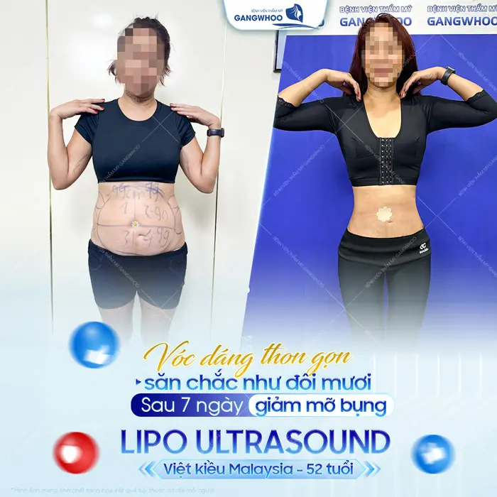 Vóc dáng săn chắc vòng eo nuột nà cho chị khách Việt Kiều nhanh về lại dáng sau phẫu thuật 