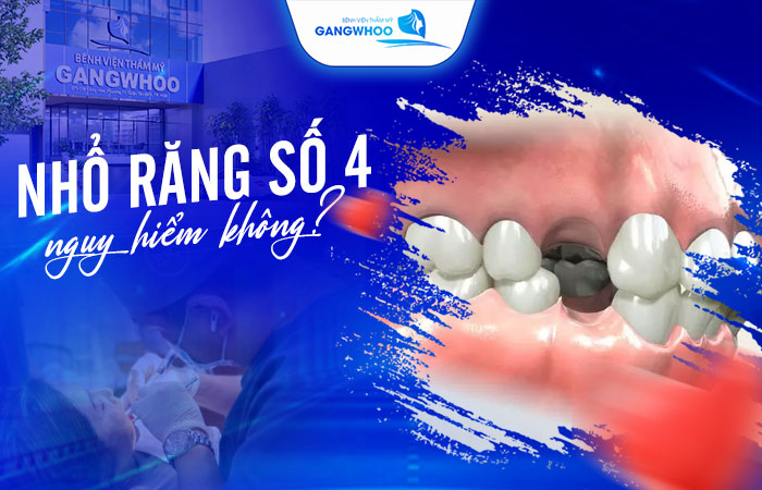 Nhổ Răng Số 4 Có Nguy Hiểm Không