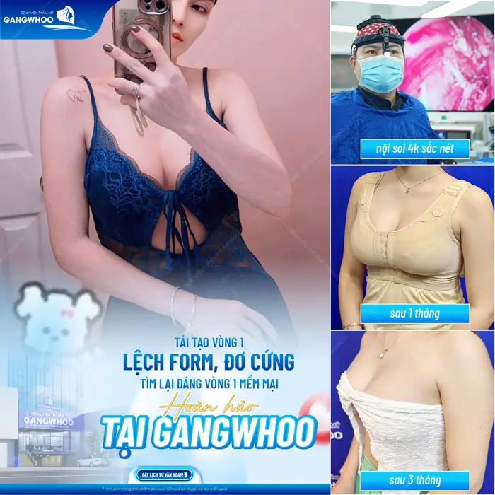 Nâng Ngực Có Cho Con Bú Được Không? Bác Sĩ Giải Đáp