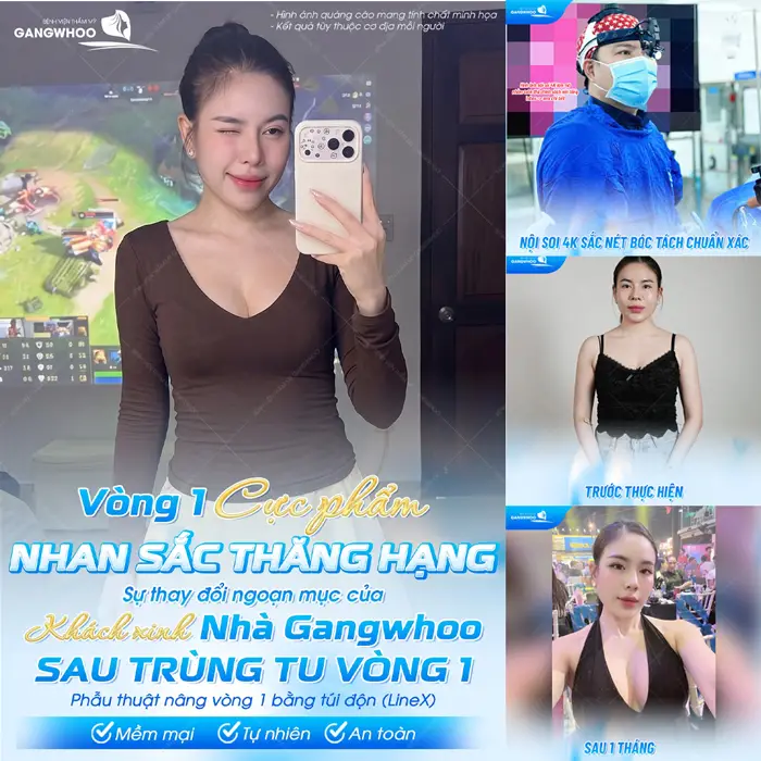 Review Nâng Ngực Thực Tế Từ A – Z Chi Tiết 6 Vòng 1 cực phẩm nhan sắc thăng hạng sự thay đổi ngoạn mục của khách hàng nhà Gangwhoo sau trùng tu vòng 1