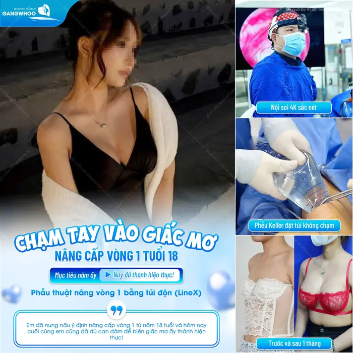 Nâng cấp vòng 1 ở tuổi 18 đẹp chuẩn mềm mại, hài hòa và tự nhiên với vóc dáng của cơ thể