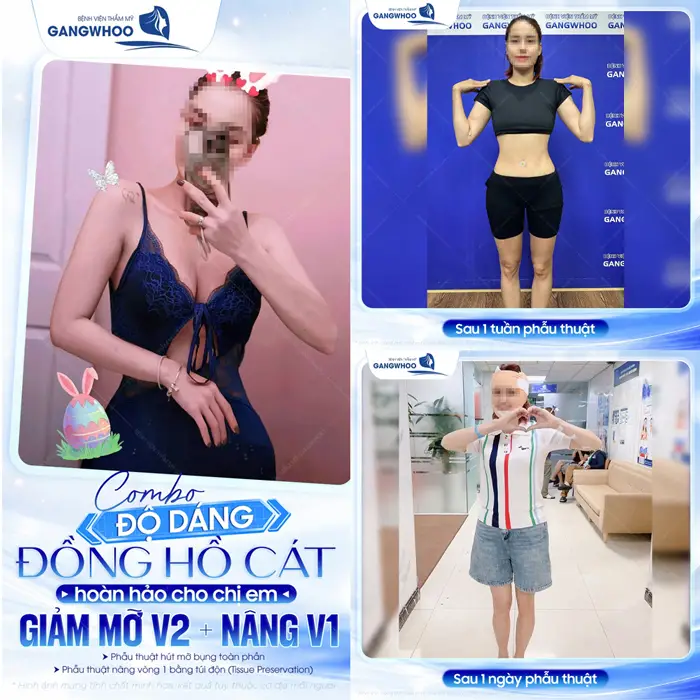 Combo độ dáng đồng hồ cát body hoàn hảo cho hội chị em vừa nâng vòng 1 vừa giảm vòng 2