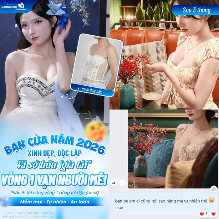 Phẫu thuật nâng cấp vòng 1 bằng túi độn cao cấp vòng 1 đẹp chuẩn vạn người mê