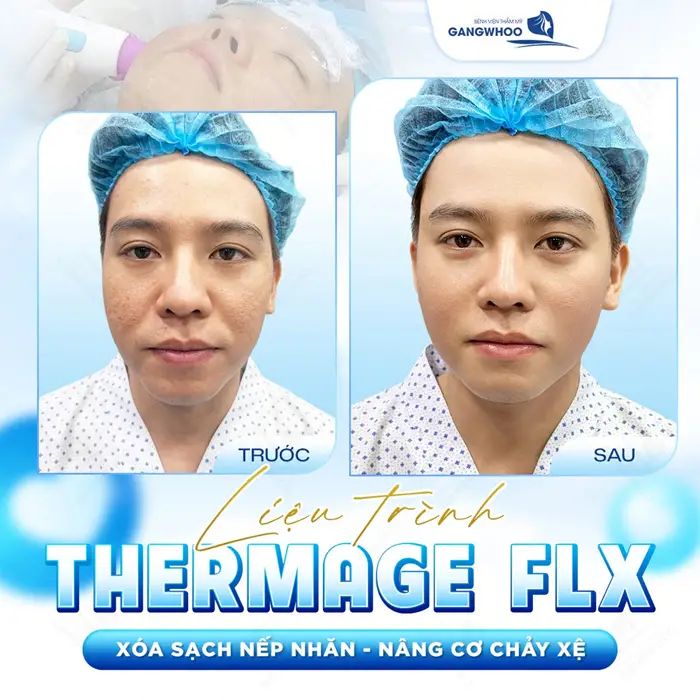 Liệu trình Thermage FLX xóa sạch nếp nhăn, giải pháp nâng cơ chảy xệ an toàn và hiệu quả