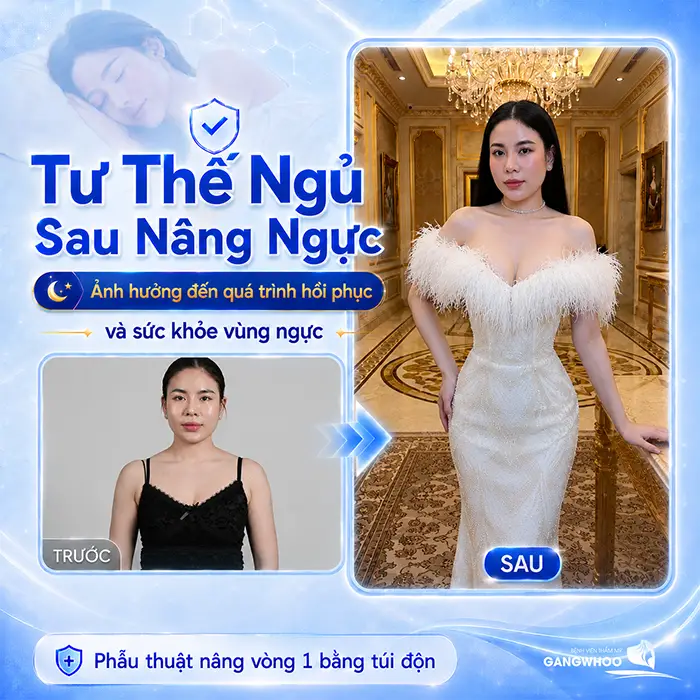 Nâng Ngực Bao Lâu Thì Được Nằm Nghiêng? Bác Sĩ Giải Đáp