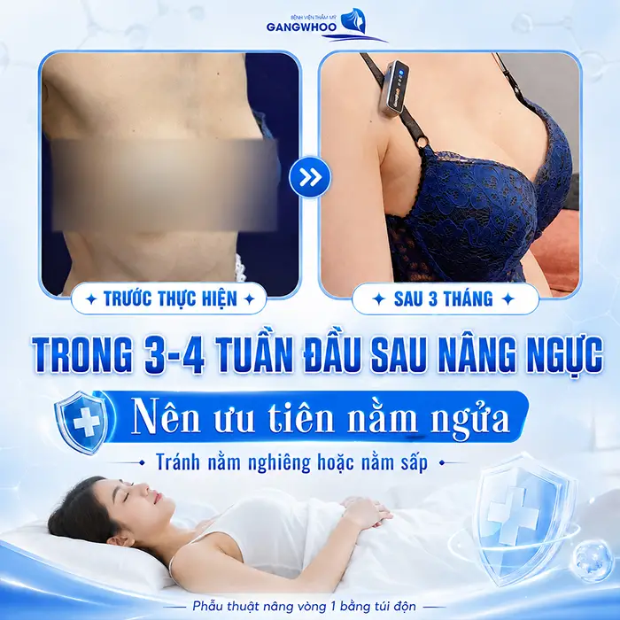 Nâng Ngực Bao Lâu Thì Được Nằm Nghiêng? Bác Sĩ Giải Đáp