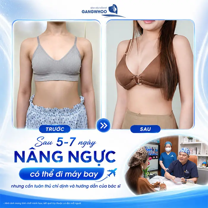 Nâng Ngực Có Đi Máy Bay Được Không? Bao Lâu Đi Được 2 Nâng Ngực Có Đi Máy Bay Được Không? Bao Lâu Đi Được