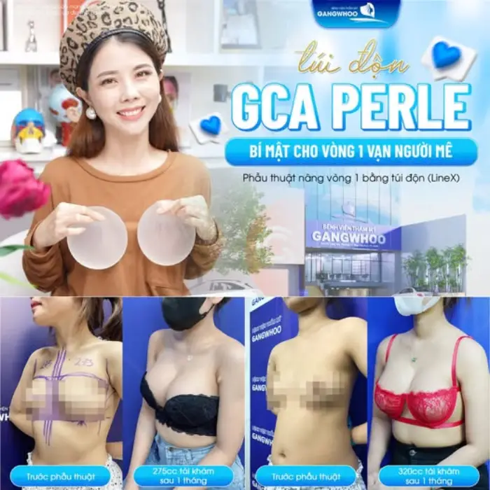 Nâng ngực GCA-Perle: Vòng 1 căng tròn, gợi cảm, đẹp tự nhiên