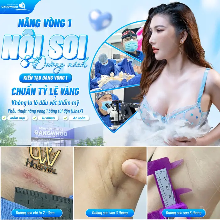 Nâng vòng 1 nội soi đường nách kiến tạo vòng 1 chuẩn tỷ lệ vàng không lo lộ dấu vết thẩm mỹ
