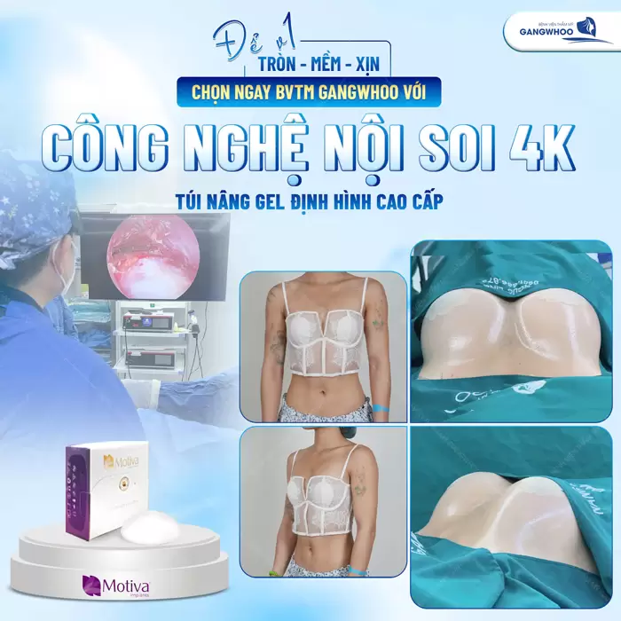 Nâng ngực được thực hiện với công nghệ chuẩn và túi độn cao cấp mang lại sắc vóc quyến rũ mềm mại