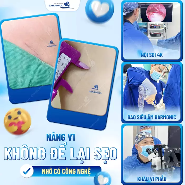 Sẹo Nâng Ngực Có Đáng Lo Ngại Không? Cách Ngừa Sẹo Nâng Ngực 4 Nâng vòng 1 không để lại sẹo xấu nếu được áp dụng công nghệ hiện đại trong phẫu thuật