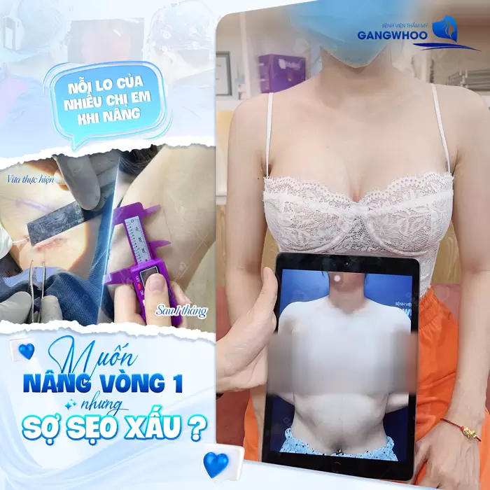 Sẹo Nâng Ngực Có Đáng Lo Ngại Không? Cách Ngừa Sẹo Nâng Ngực 1 Giải đáp nhanh nâng ngực có để lại sẹo xấu hay không? Tìm hiểu ngay