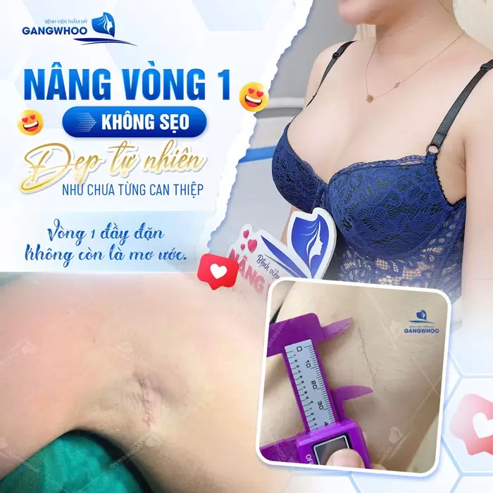 Sẹo Nâng Ngực Có Đáng Lo Ngại Không? Cách Ngừa Sẹo Nâng Ngực 2 Nâng vòng 1 không sẹo xấu đẹp tự nhiên như chưa từng can thiệp