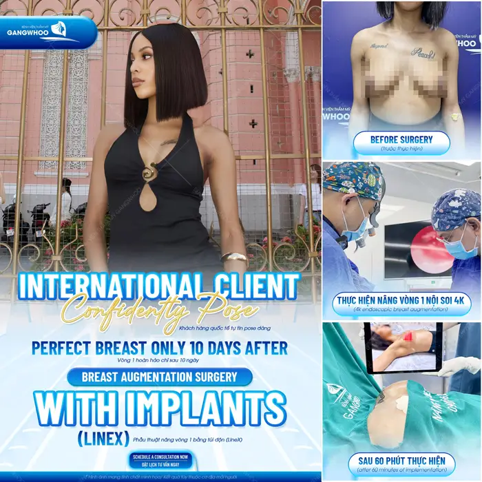 Phẫu thuật nâng cấp vòng 1 bằng túi độn cao cấp tôn nét đẹp cho đường cong thêm quyến rũ 