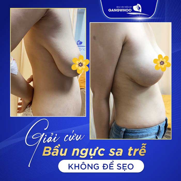 breast augmentation process at Gangwhoo Cosmetic Hospital