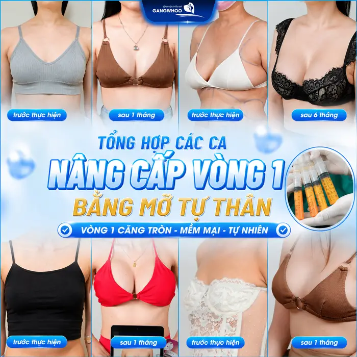 Quy Trình Nâng Ngực Bằng Mỡ Tự Thân? Chi Tiết Trong 6 Bước