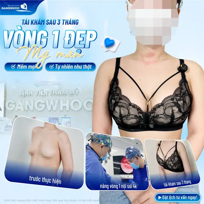Nâng Ngực Nội Soi Ở Đâu Tốt? 10 Địa Chỉ Tốt Ở TPHCM 2 Tái khám sau 3 tháng nâng cấp vfong 1 đẹp mỹ mãn mề mại, tự nhiên như thật
