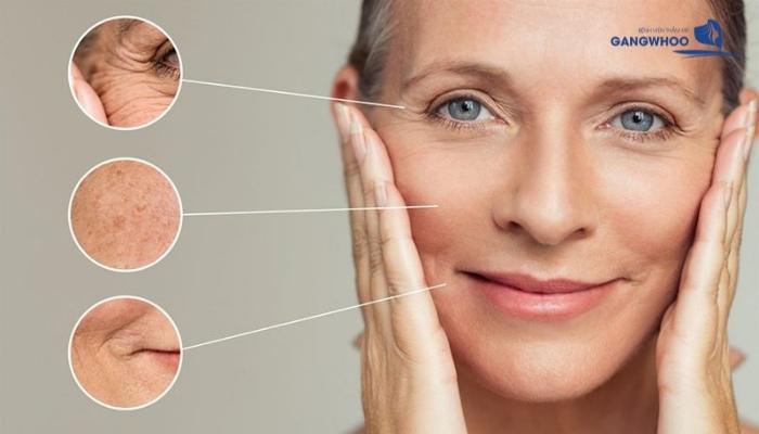 Căng Da Mặt Bằng Chỉ Nâng Cơ Lifting Collagen có thể sử lí tất cả các vùng da trên mặt