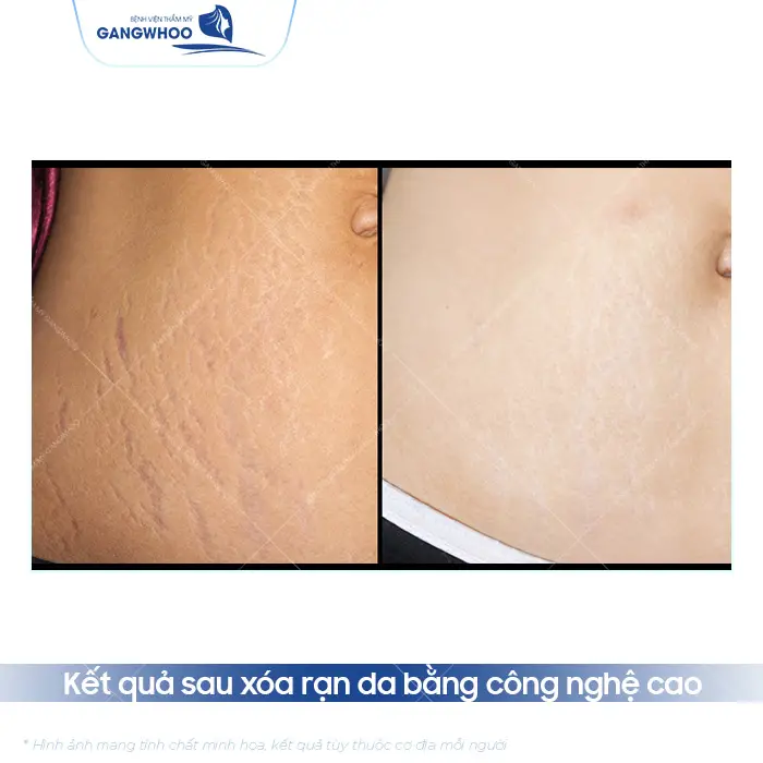 Xóa Rạn Da Lâu Năm Công Nghệ Chuẩn Hàn 4 Xóa Rạn Da Lâu Năm Công Nghệ Chuẩn Hàn