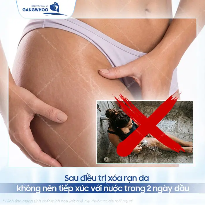 Xóa Rạn Da Lâu Năm Công Nghệ Chuẩn Hàn 5 Xóa Rạn Da Lâu Năm Công Nghệ Chuẩn Hàn