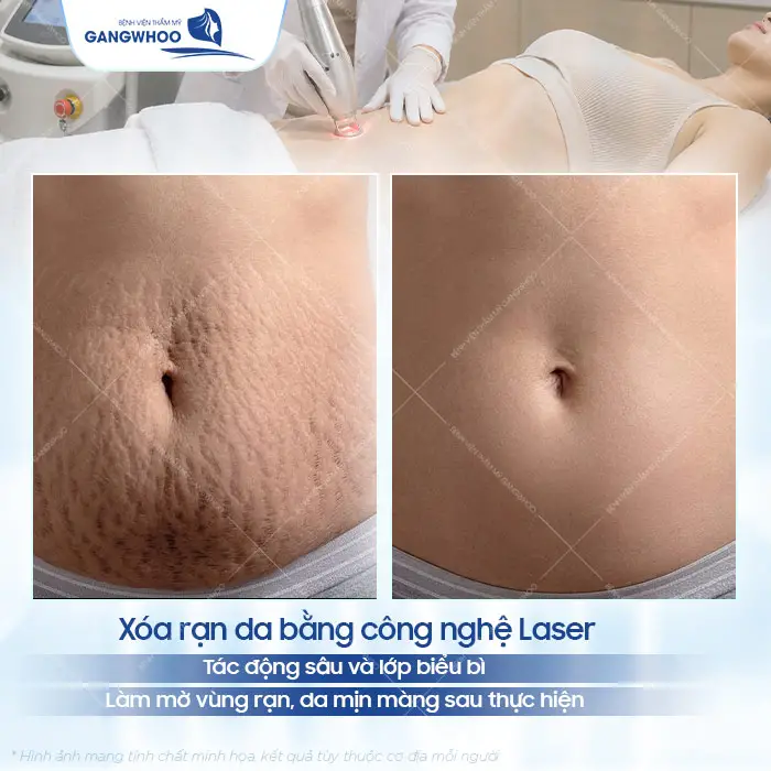 Xóa Rạn Da Lâu Năm Công Nghệ Chuẩn Hàn 3 Xóa Rạn Da Lâu Năm Công Nghệ Chuẩn Hàn