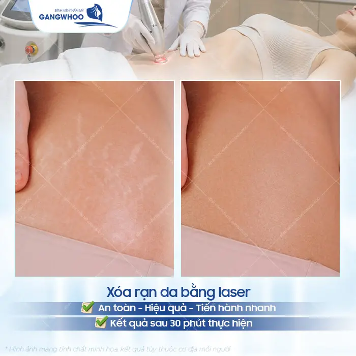 Xóa Rạn Da Lâu Năm Công Nghệ Chuẩn Hàn 2 Xóa Rạn Da Lâu Năm Công Nghệ Chuẩn Hàn