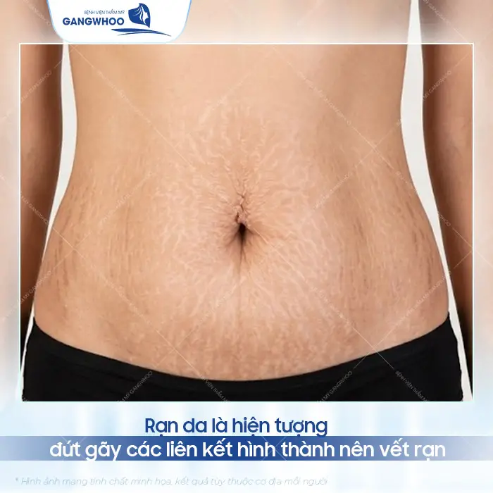 Xóa Rạn Da Lâu Năm Công Nghệ Chuẩn Hàn 1 Xóa Rạn Da Lâu Năm Công Nghệ Chuẩn Hàn