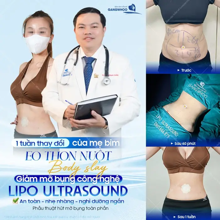 1 tuần thay đổi của mẹ bỉm eo thon nuột body đẹp siêu slay với công nghệ giảm mỡ bụng Lipo Ultrasound hiện đại 