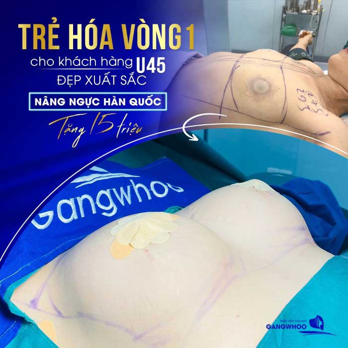 Ảnh khách hàng thẩm mỹ tại BVTM Gangwhoo