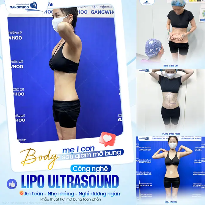 Giảm mỡ bụng công nghệ Lipo Ultrasound màn lột xác ngoạn mục cho mẹ bỉm 1 con 