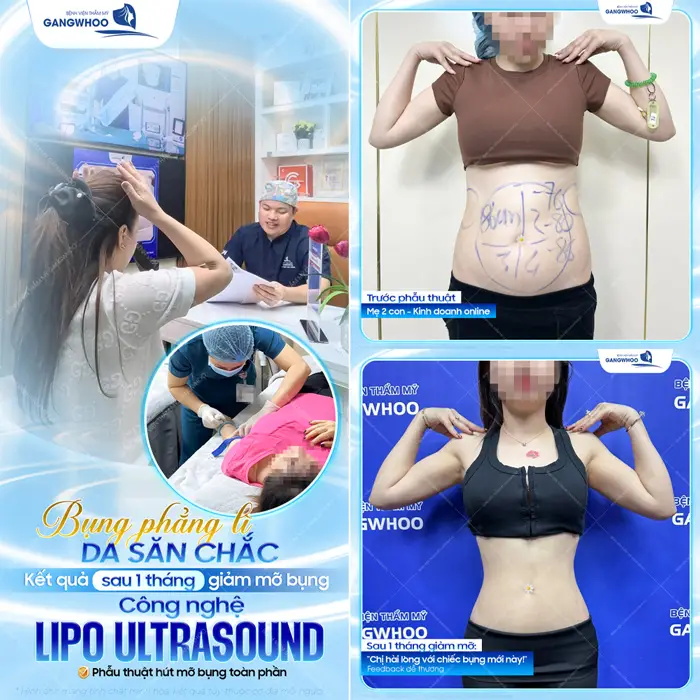 Bụng phẳng lì vòng eo săn chắc kết quả sau 1 tháng thưucj hiện giảm mỡ công nghệ Lipo Ultrasound đã tự tin với săc vóc mới