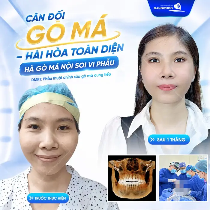 Tìm Hiều 5 Cách Hạ Gò Má Không Cần Phẫu Thuật An Toàn 4 Hạ gò má nội soi vi phẫu đường nét hài hòa diện mạo thêm trẻ trung sau 1 tháng nhan sắc đã thăng hạng