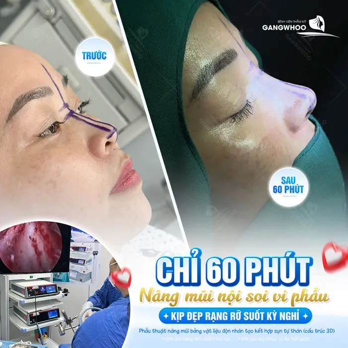 Chỉ sau 60 phút nâng mũi nội soi vi phẫu kịp đẹp đón lễ với nhan sắc và thần thái rạng rỡ