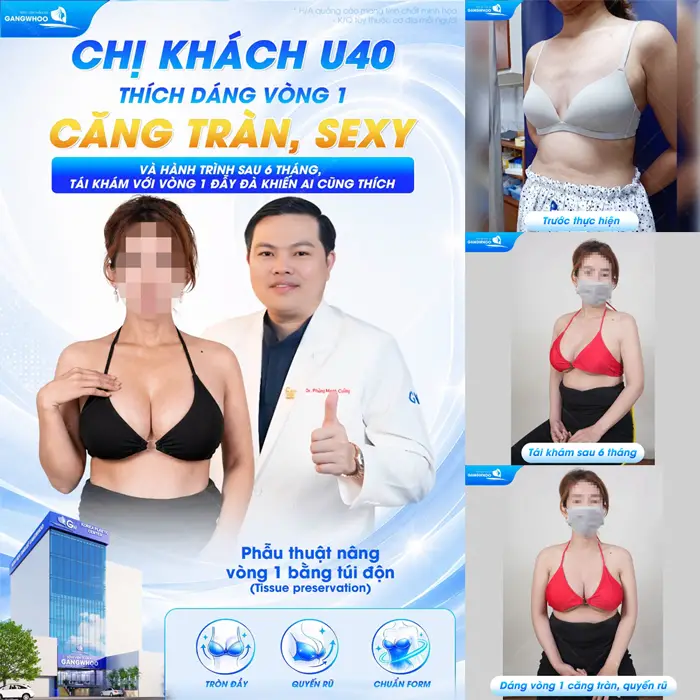 Chị khách U40 thích dáng vòng 1 căng tràn, sexy và hành trình sau 6 tháng tái khám với vòng 1 đẫy đà 