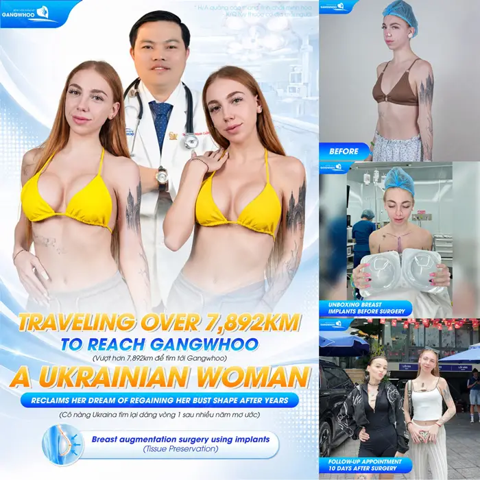 Khách hàng đến từ Ukraina tự tin pose dáng xinh đẹp sau nâng cấp vòng 1 tại bệnh viện thẩm mỹ Gangwhoo 