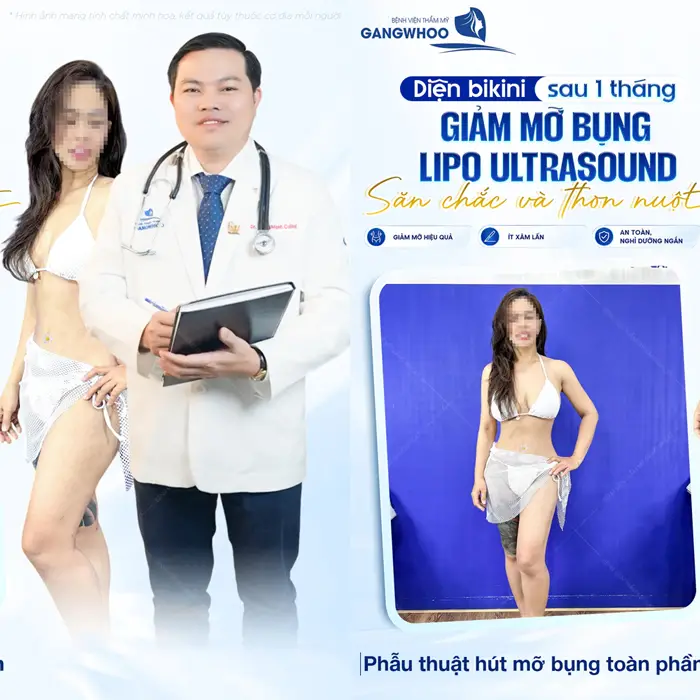 Review 14+ Địa Chỉ Hút Mỡ Bụng Ở Hà Nội Chất Lượng Cao 6 Sau 1 tháng giảm mỡ bụng Lipo Ultrasound săn chắc và thon gọn hơn