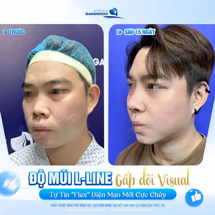 Độ mũi L Line gấp đôi visual tự tin flex diện mạo cực cháy 