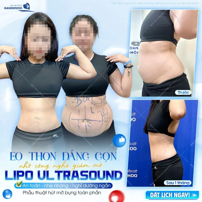 Eo thon dáng gọn nhờ công nghệ giảm mỡ Lipo Ultrasound an toàn và nhẹ nhàng sau 1 tháng đã thon đẹp thấy rõ