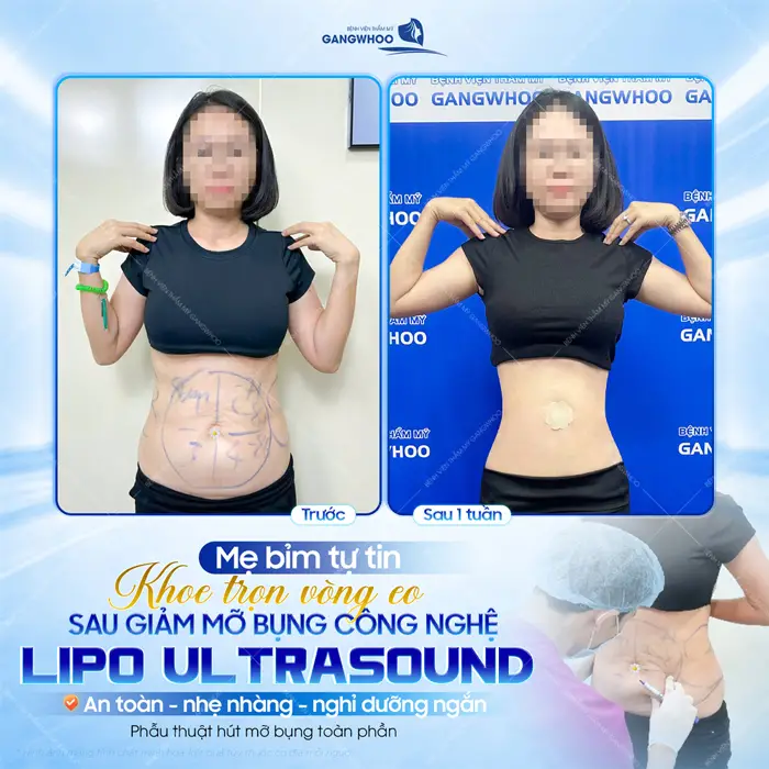 Mẹ bỉm tự ti khoe trọn vòng eo sau giảm mỡ bụng công nghệ Lipo Ultrasound an toàn, nhẹ nhàng và nghỉ dưỡng ngắn